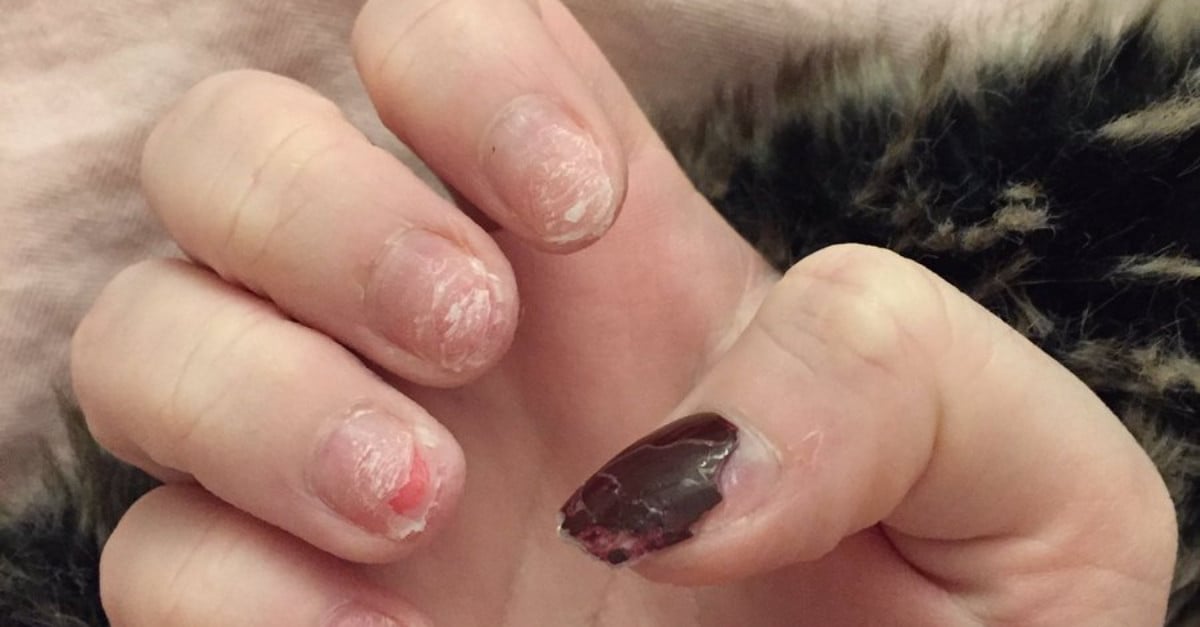 Viral Tweet Shows the Damage Done by Acrylic Nails POPSUGAR Beauty