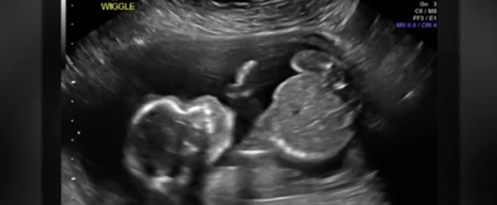 Baby Punching Himself During an Ultrasound