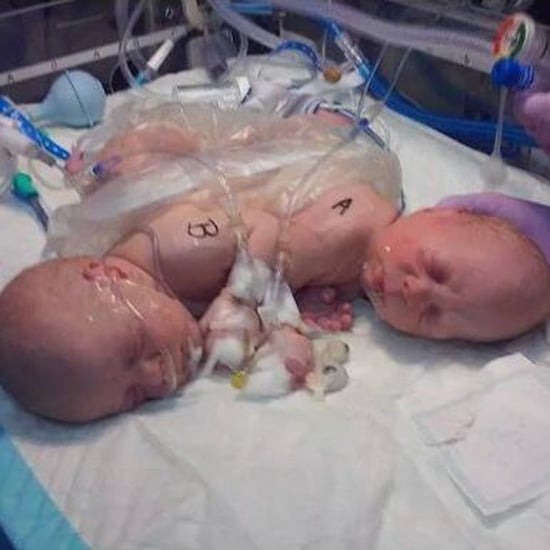 Conjoined Twins Born in Florida