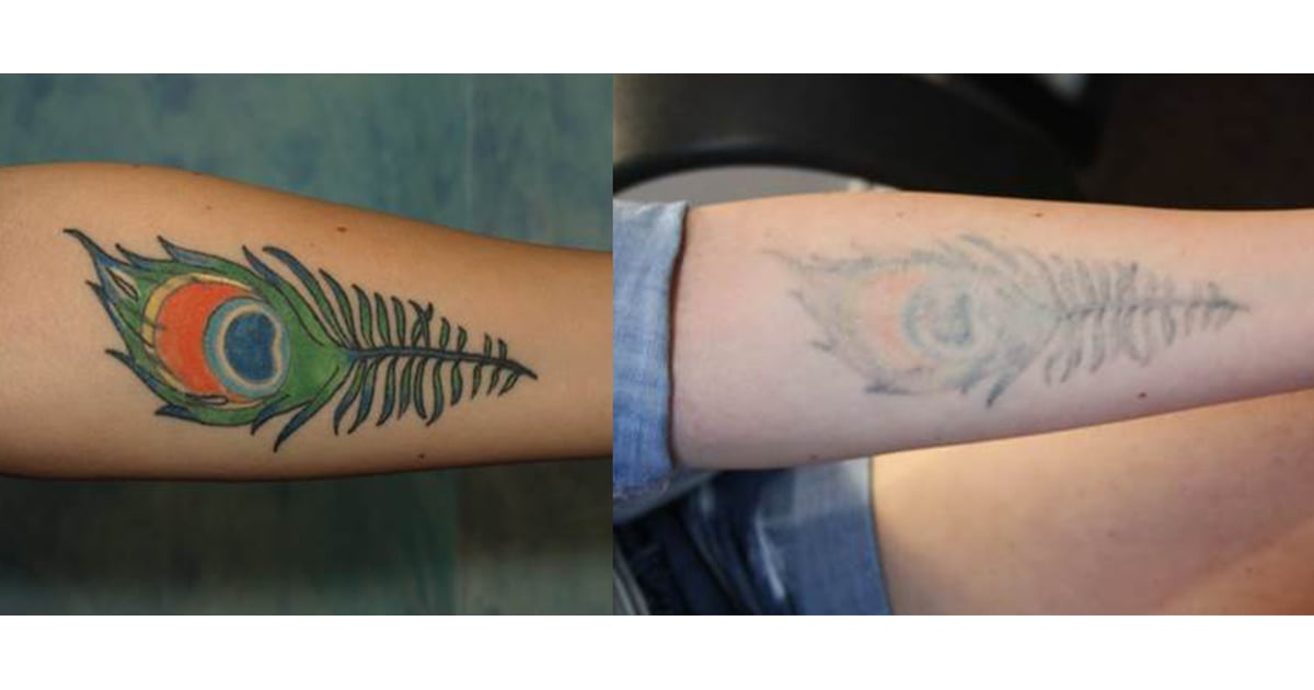 How to Get Rid of a Tattoo  POPSUGAR Beauty