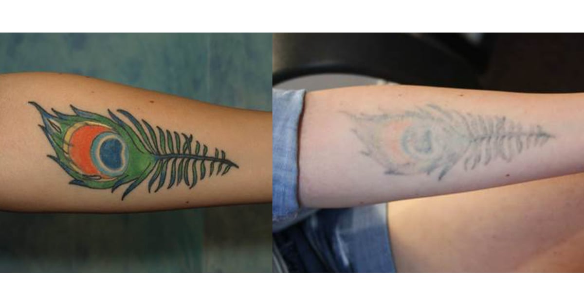 How to Get Rid of a Tattoo | POPSUGAR Beauty