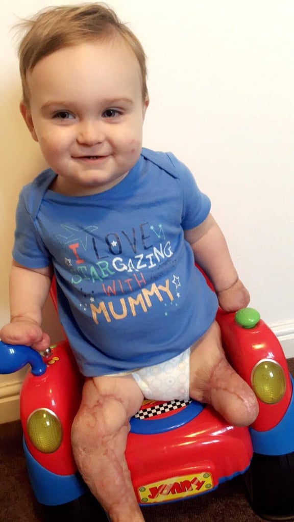 Boy With Amputations From Meningitis Takes First Steps