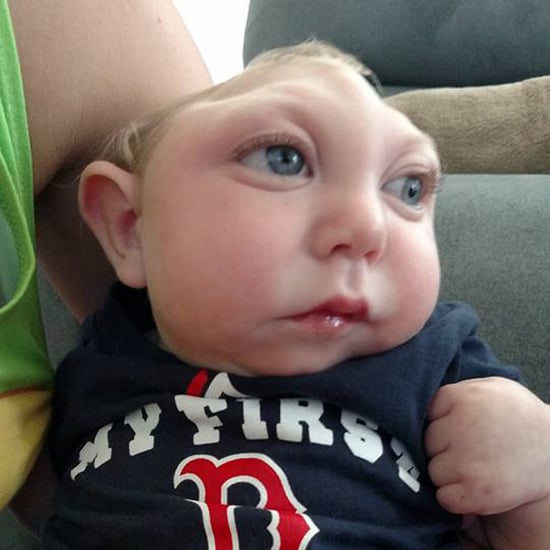 Baby Born Missing Most of His Skull Celebrates Birthday