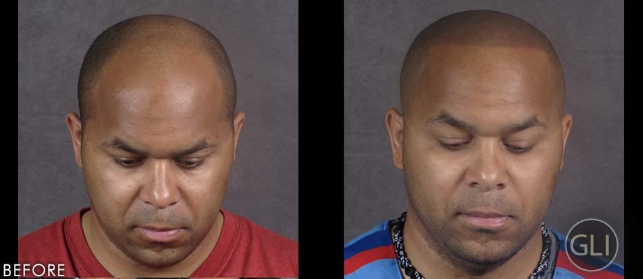 Makeup Beauty Hair Skin How Scalp Tattoos Are Empowering Men