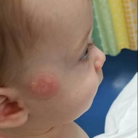 Mom's Warning on Pacifiers After Son Gets Burned