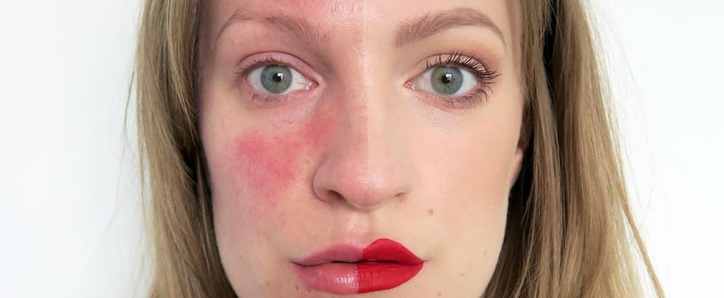 People Embracing Skin Conditions on Instagram
