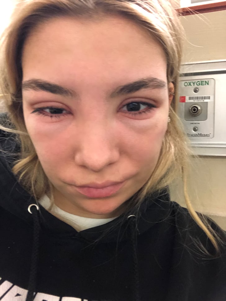 3 Days After the Lash Tint Allergic Reaction to Eyelash Tint