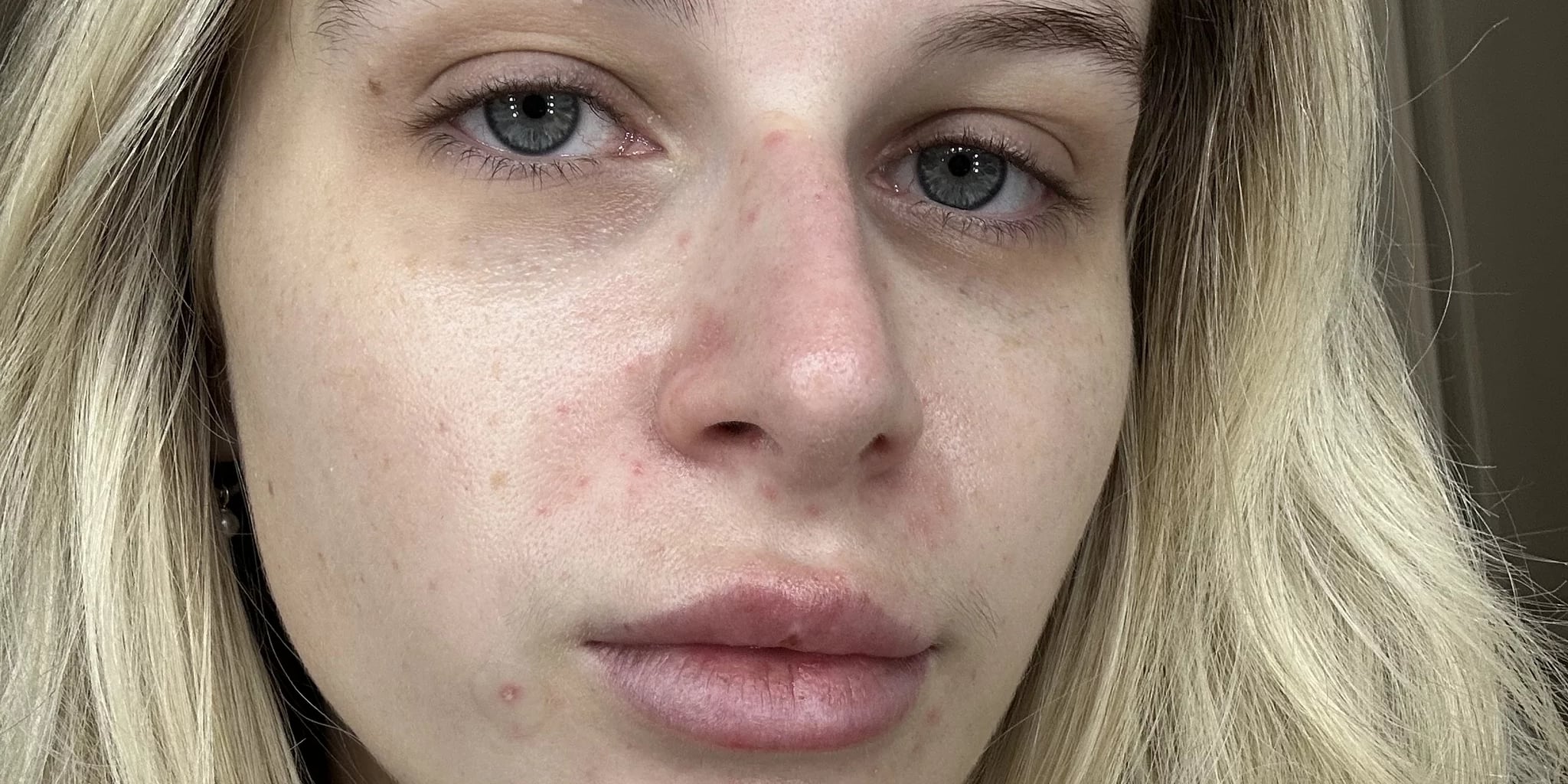 Differin Acne-Prone Skin Patches Review With Photos - Vimarsana News