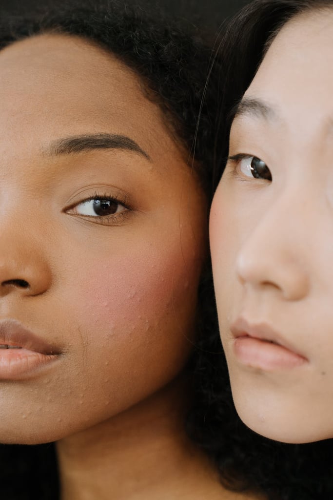 What Are the Types of Acne Scars?
Generally speaking, there are two types of scarring: superficial and deep indented scars. 
"If you feel a divot or textural irregularities in the skin, those are referred to as deep or indented scars," Dr. Guanche says. "Superficial scars are often referred to as post-inflammatory erythema and do not typically have textural indentations in the skin. This type of scarring will heal over time without treatment." 
Although oily skin tends to be more acne prone, all skin types are susceptible to acne and acne scars. There are differences in the way skin will heal: "Some can have deep cystic breakouts that look disfiguring but then heal with perfectly smooth skin," Dr. Guanche says. "Others can have a mild breakout that results in permanent noticeable scars. The difference is likely genetics."
Then, to get more granular, there are four main types of acne scarring: boxcar (broad depressions with sharply defined edges); icepick (deep, narrow, pitted scars); rolling (broad depression with a sloping edge); and hypertrophic scars or keloids (raised, thick, lumpy scars).