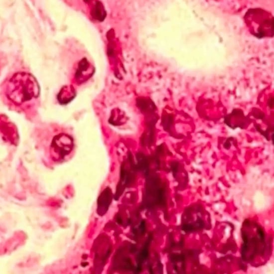 Measles Outbreak in Texas Caused by Anti-Vaxxers