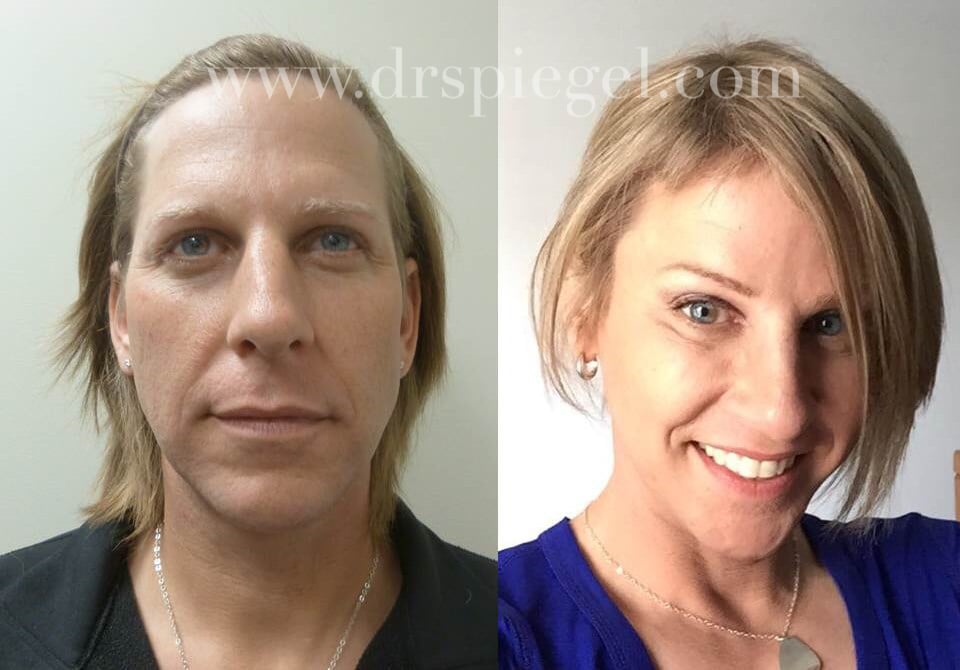 Transgender Surgeries Male To Female Popsugar Beauty