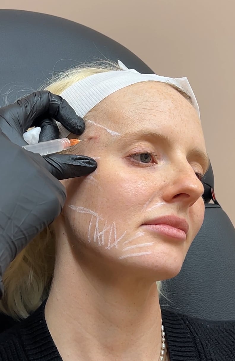 One editor gets Sculptra injections for glowy skin