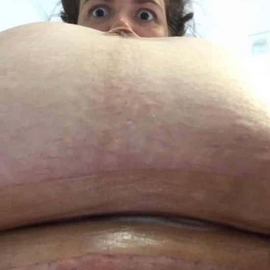 Mom Posts Before-and-After C-Section Photos of Belly