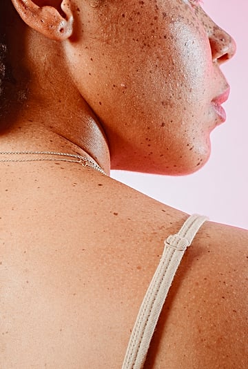 How to Remove Skin Tags, According to Experts