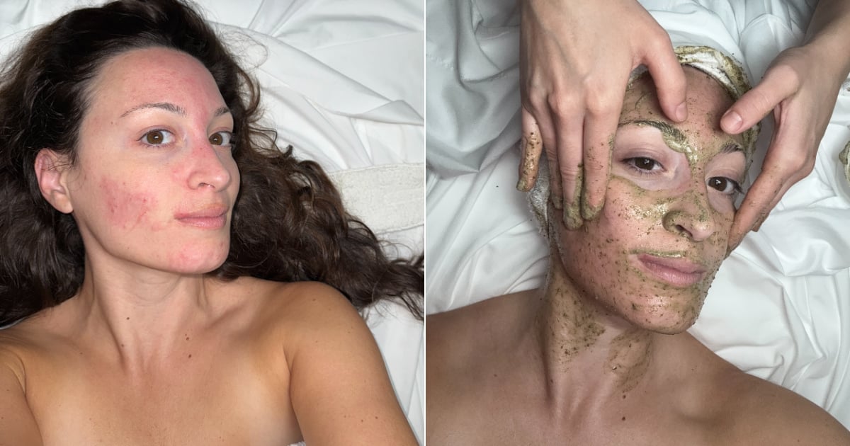 I Tried a "Fiberglass Facial," and It Made My Skin Look So Good