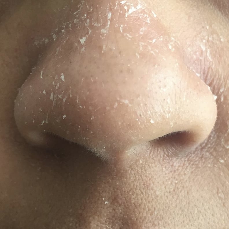 Facial Dandruff How to Treat It, According to a Skin Expert POPSUGAR