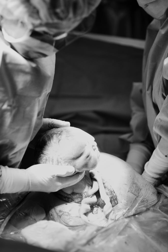 Dramatic C-Section Birth Photos