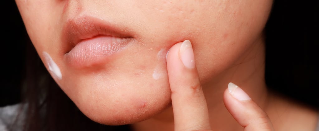 What Is Benzoyl Peroxide?