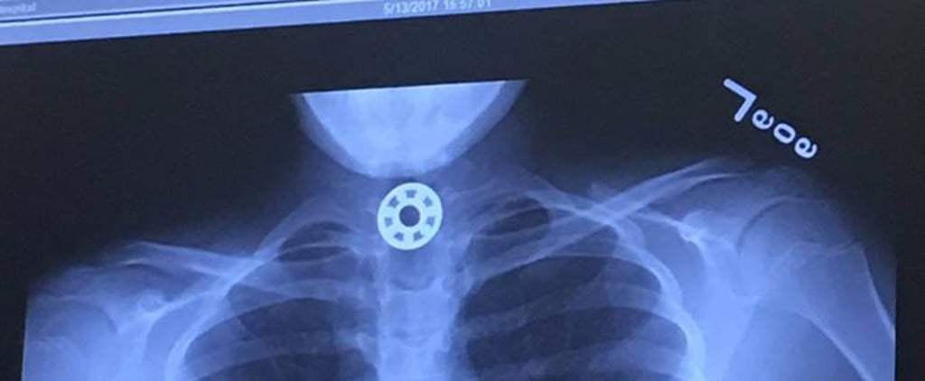 Kid Choking on a Fidget Spinner