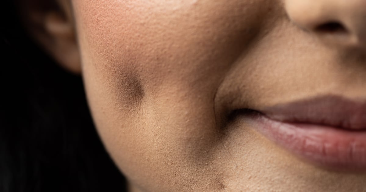 Dimpleplasty Surgery Cost, Downtime, and Potential Risks POPSUGAR