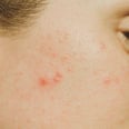 Severe Acne: A Breakdown of Types, Treatments, and More