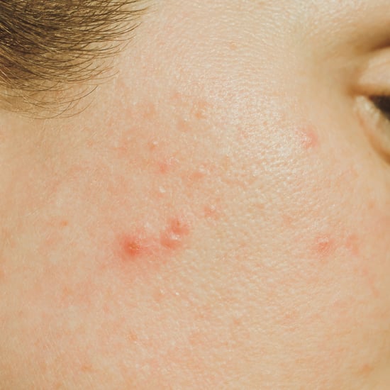 Severe Acne: Types, Treatments, and Tips