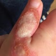 Mom's Important Warning After a Vacuum Gave Her Toddler Fourth Degree Burns