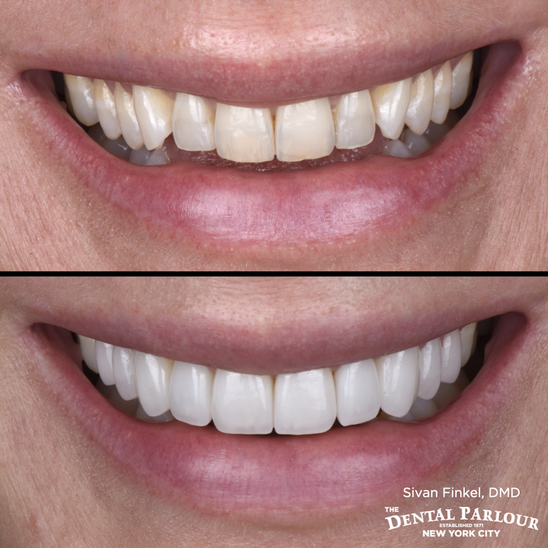 Veneers before and after