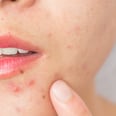 Can Polycystic Ovary Syndrome Cause Acne? We Asked Two Dermatologists to Explain