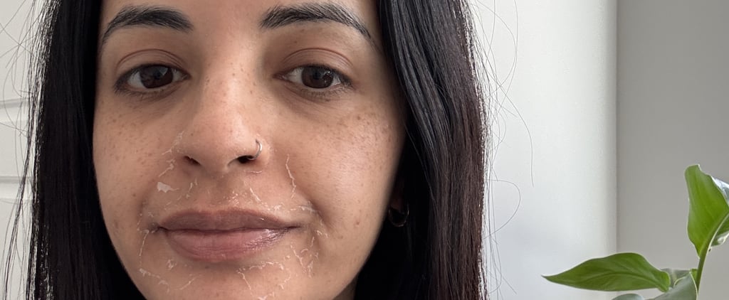 VI Peel Review For Acne and Dark Spots: See Photos