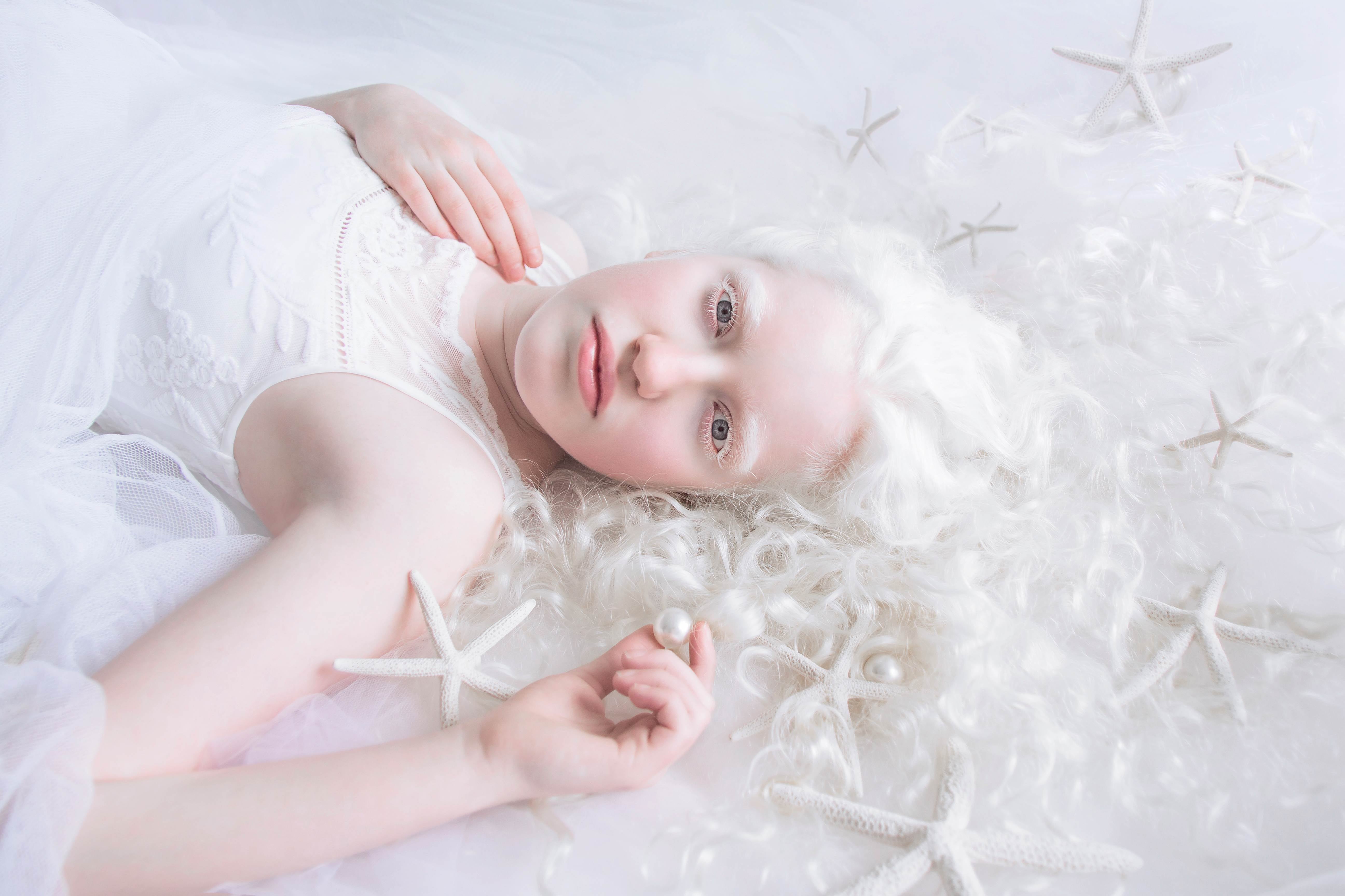 Partial Albinism In Humans