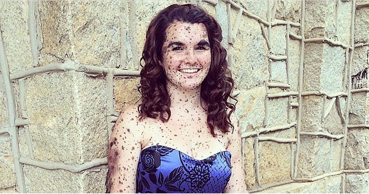 Girl With Hundreds Of Birthmarks Embraces Her Skin Popsugar Beauty 