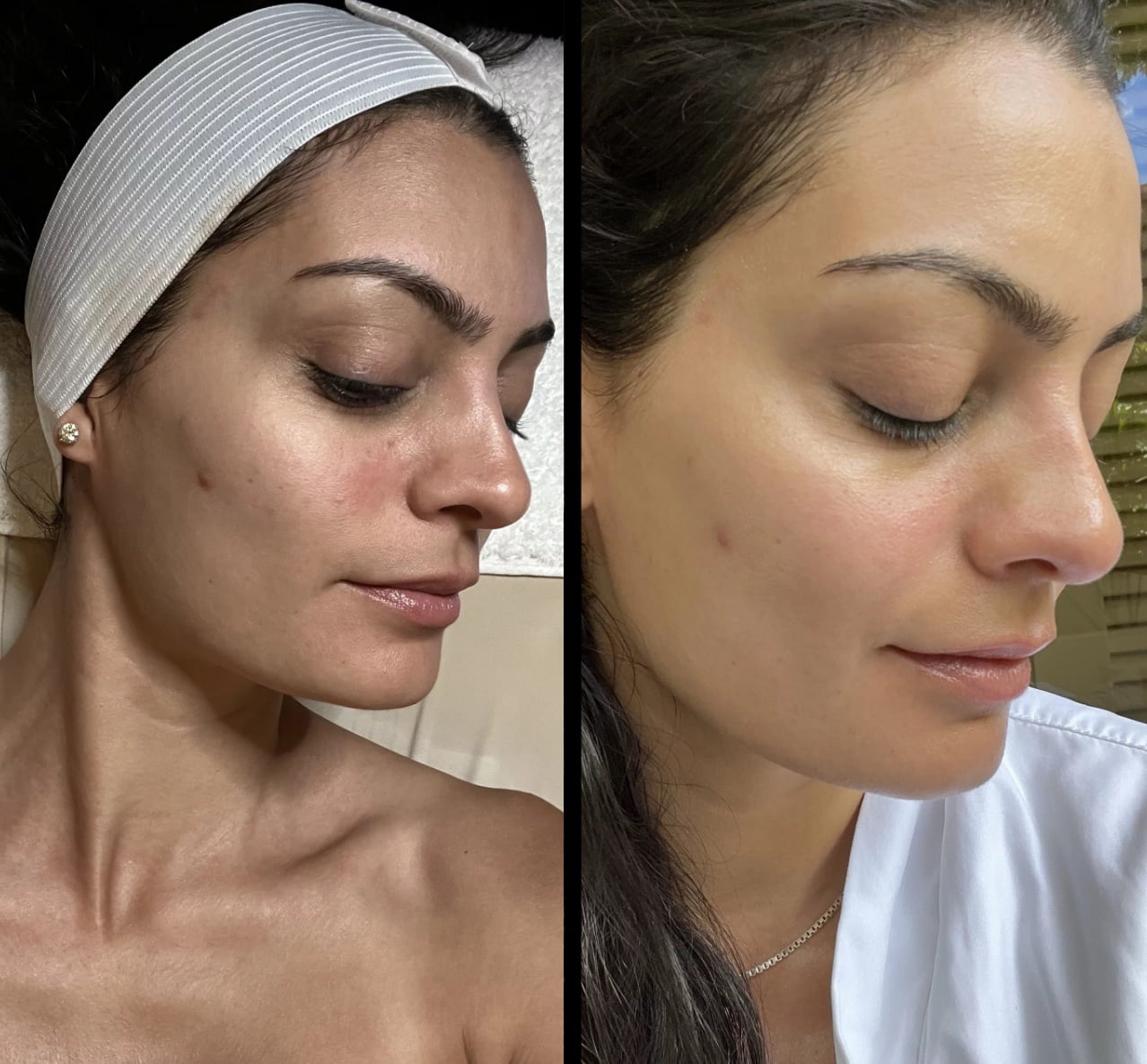 I Got a $500 Non-Surgical Lift Facial — Was It Worth It?