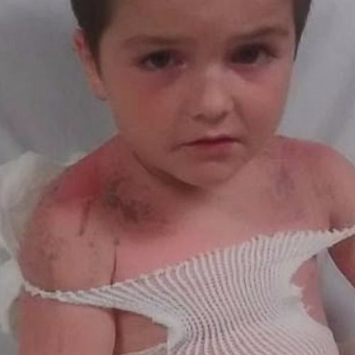 Boys Suffer Second- and Third-Degree Sunburns