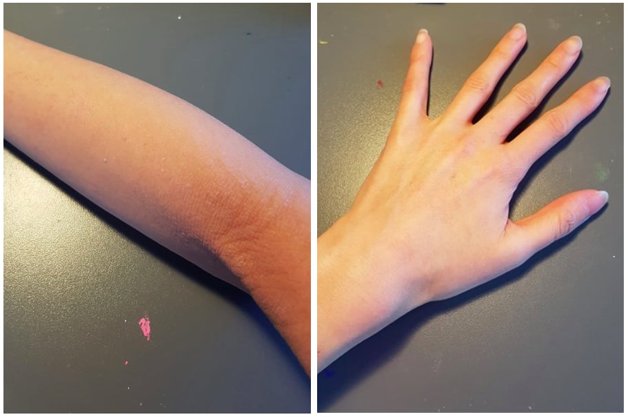 How to Stop Using Steroid Cream POPSUGAR Beauty