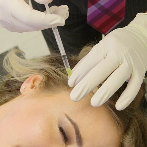 Blotox Botox For the Scalp