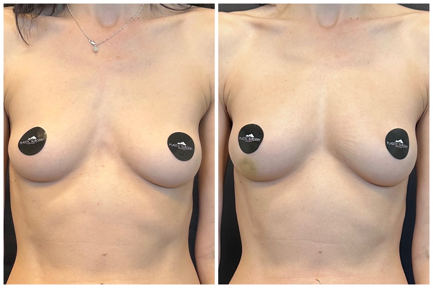 Before and after fat vampire breast augmentation.