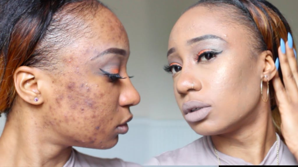 Foundation For Acne Scars With Color Correcting | Color-Correcting Tutorials That Will Change the Way You Apply Concealer | POPSUGAR Beauty