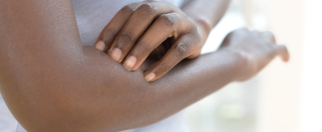 How to Get Rid of Stress Hives, According to MDs