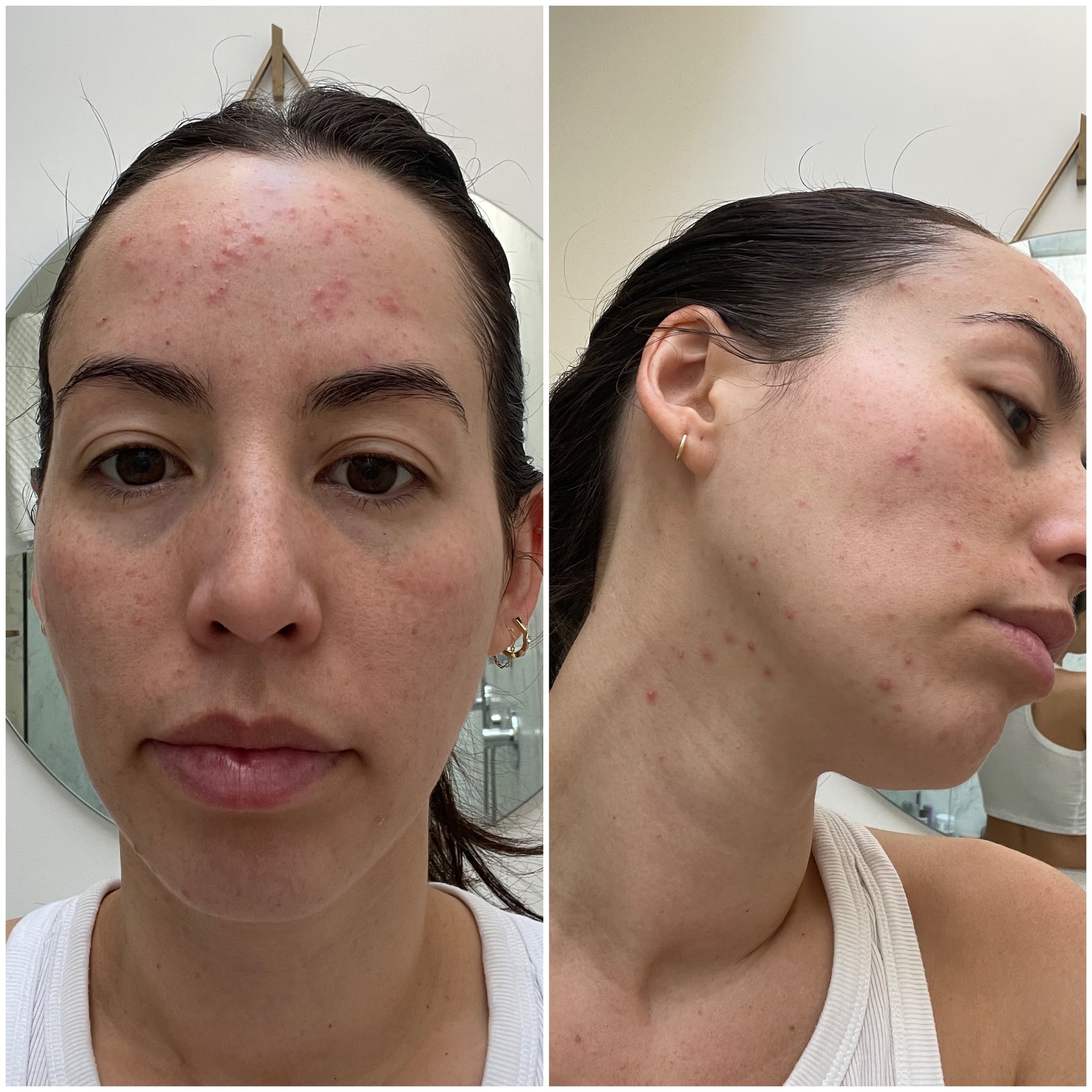 steroid acne photos 