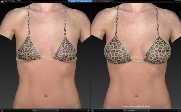 vectra 3d imaging plastic surgery