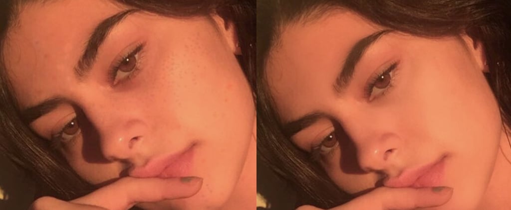 Why I Don't Photoshop My Acne on Social Media Anymore