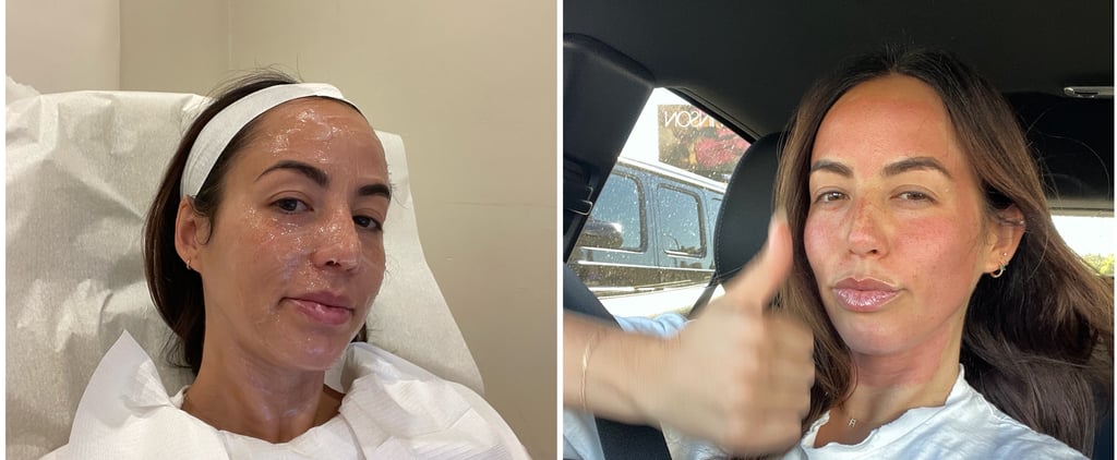 I Tried SkinPen, the Victoria Beckham-Approved Treatment