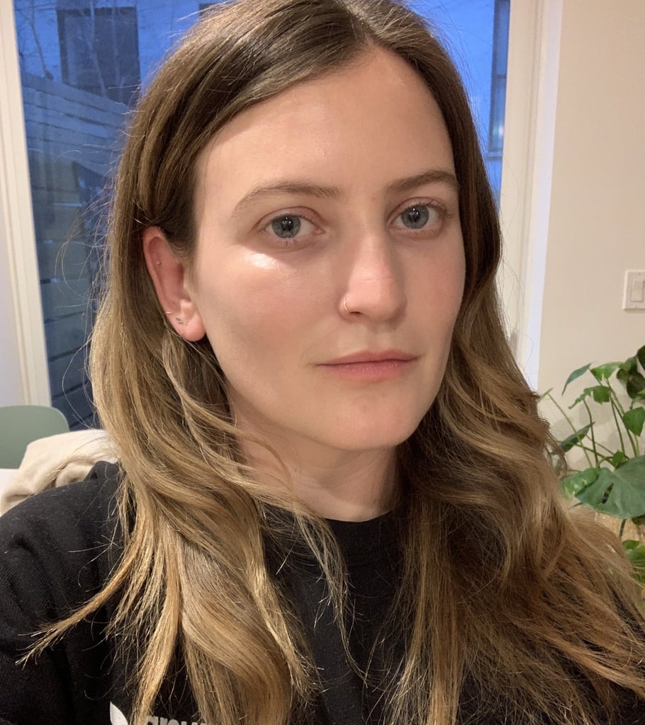 10 Days After Undereye Fillers