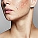 Experts Recommend the Best Acne Treatments For a Flare Up