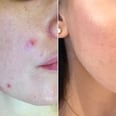 How I Cured My Acne Using Only Drugstore Products