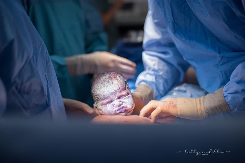 C-Section Birth Photography