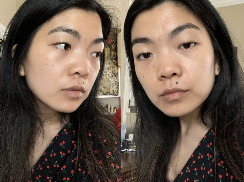 My Skin Before and Early Impressions