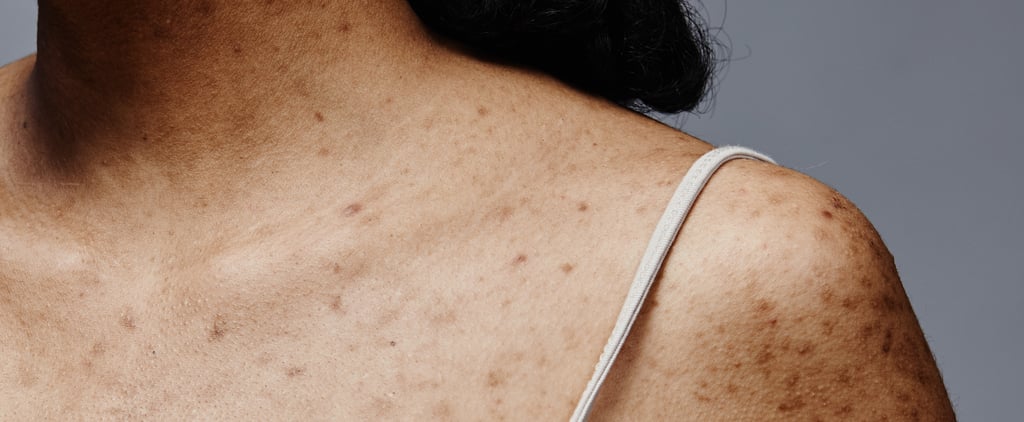 Body Acne Causes and Treatments, According to Dermatologists