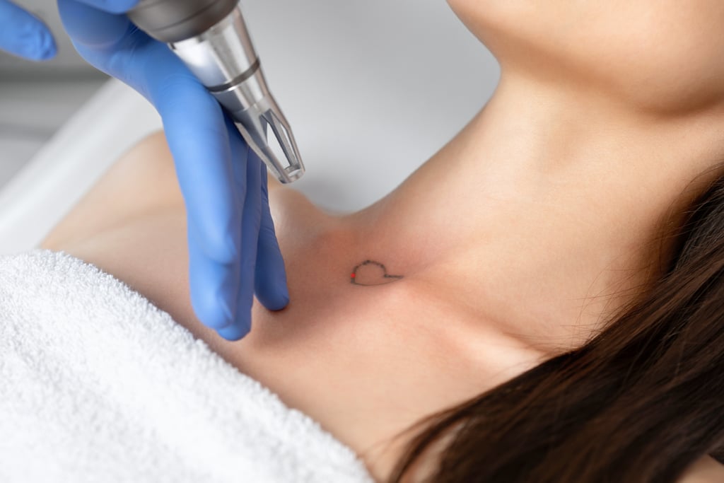 What Risks Are Associated With Laser Tattoo Removal?
As with any cosmetic procedure, laser tattoo removal does come with a few risks: "Whenever laser energy is involved, there is a risk of loss of pigment, darkening of the skin, or a change in the texture of the skin," Dr. Hartman says. He notes, however, that textural changes are rare, "since the laser targets pigment, and pigment makes up the normal skin anatomy." 
How Much Does Laser Tattoo Removal Cost?
Prices for tattoo removal largely depend on where you live, but in general, if you're looking to get a tattoo removed via laser treatment, you should know that it's not cheap. According to Dr. Hartman, the process can cost anywhere between £80 to £400 a session, depending on the size of the tattoo.
What Should I Do After Each Tattoo Removal Session?
After your tattoo removal session, the skin in the tattooed area might appear frosty, red,  and cracked, and it may also feel sensitive. This is no reason to worry, as the sensation is only temporary and can be calmed with topical products. "This is easily treated with a healing ointment like Eucerin® Aquaphor Soothing Skin Balm (£13) and resolves within days," Dr. Hartman says. "The tender sensation resolves within a couple of hours and the skin can be gently washed with a mild cleanser."
Laser Tattoo Removal Before and After